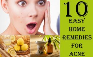 home remedies to get rid of pimples