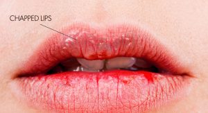 chapped-lips