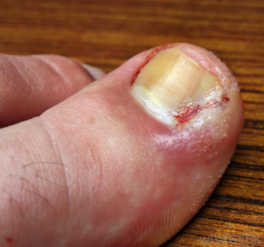 nail injuries