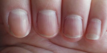 white spots on the nails