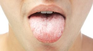 home-remedies-for-white-coated-tongue